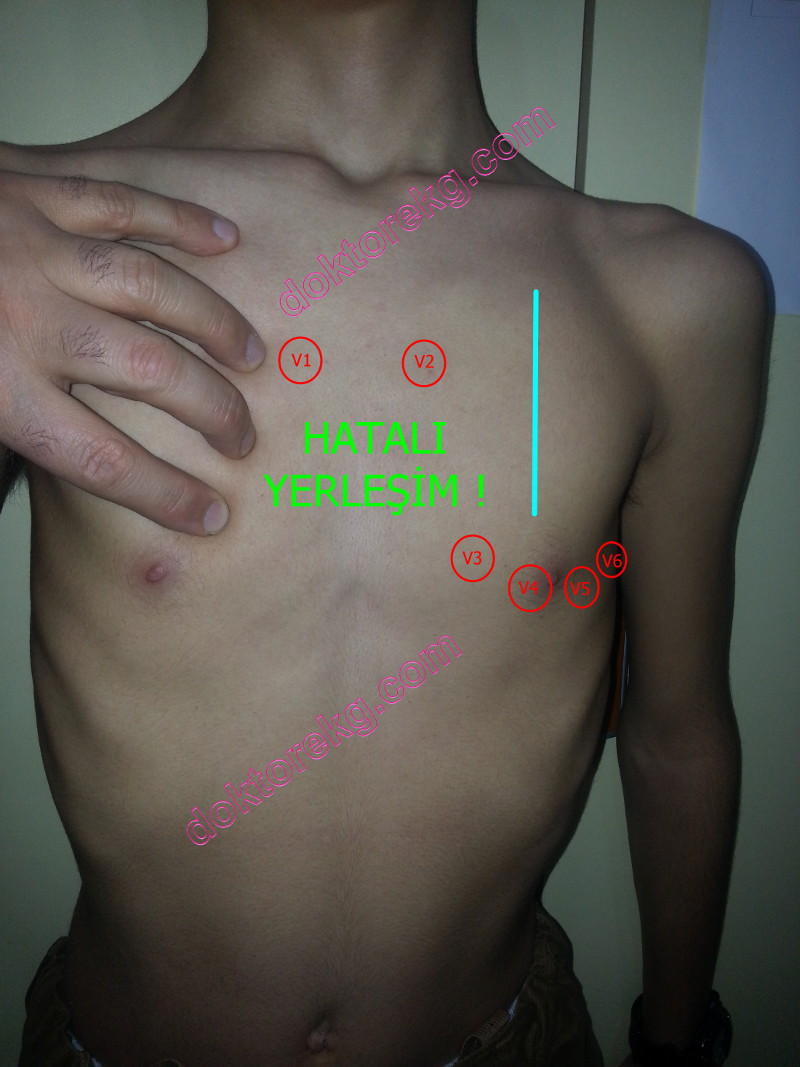 EKG V1-V6 Yerleşimi: Doğru Takma Noktaları [2026] - Kapak Görseli